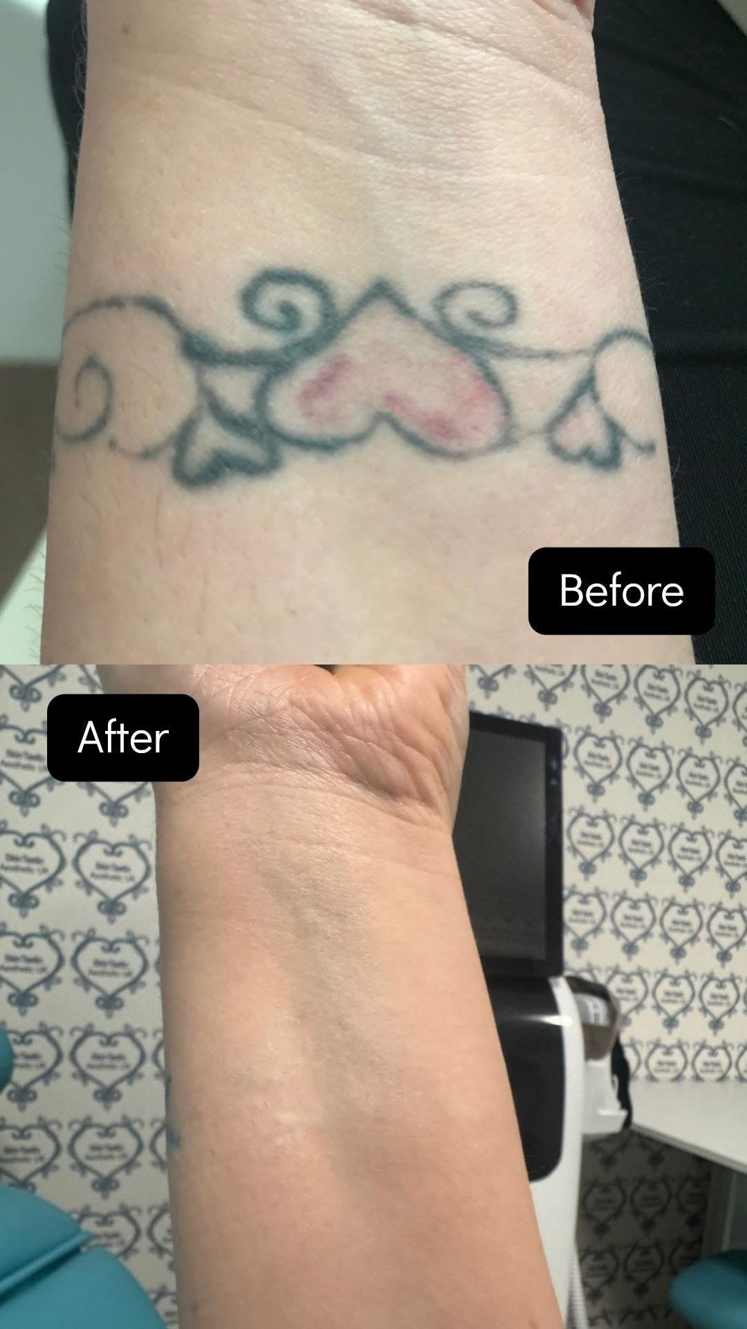 A black and pink wrist tattoo before laser tattoo removal, and the same wrist after treatment at Skintastic Southampton