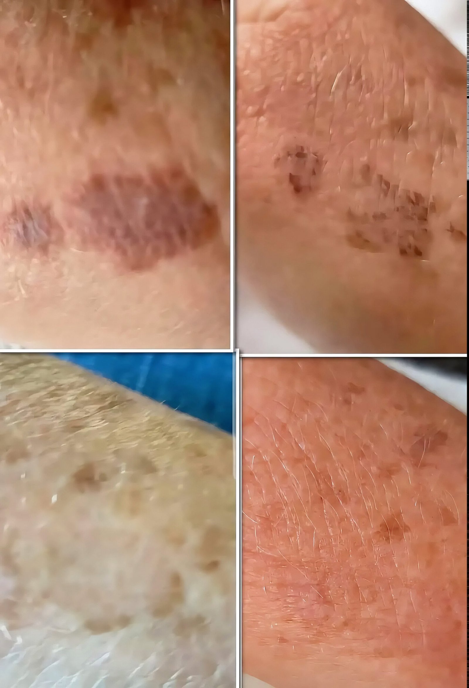 Two areas of brown pigmentation on the skin before laser pigmentation reduction, each shown beside the same area after treatment at Skintastic Southampton