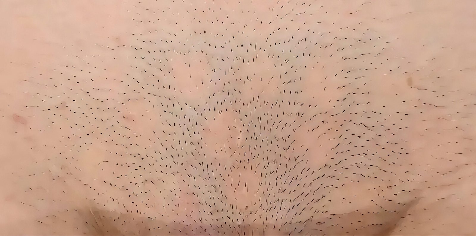 An area of skin after one session of IPL hair removal at Skintastic Southampton, showing patches with fewer visible hairs