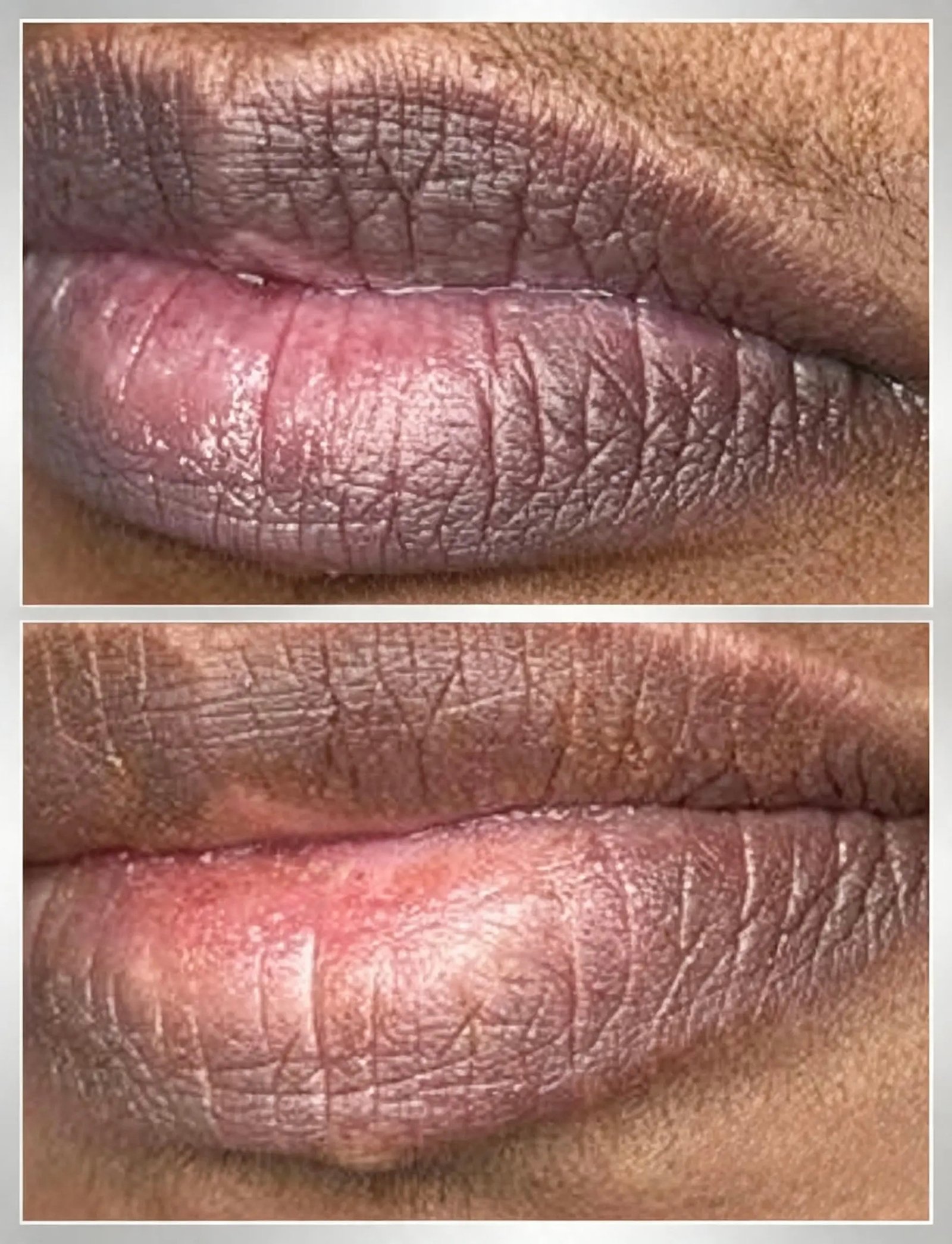Dark lip pigmentation before and after laser lip neutralisation at Skintastic Southampton
