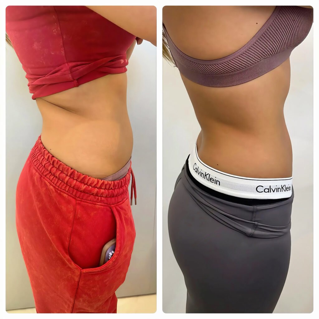 Ten sessions, twice a week Waist and stomach before and after ten EMS muscle sculpting sessions at Skintastic Southampton