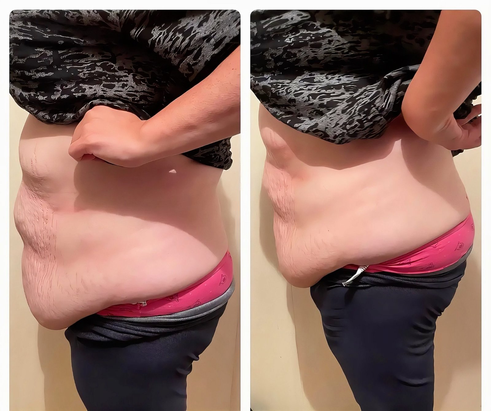 Side view of a client’s stomach before and after three fat freezing cryolipolysis sessions at Skintastic in Southampton