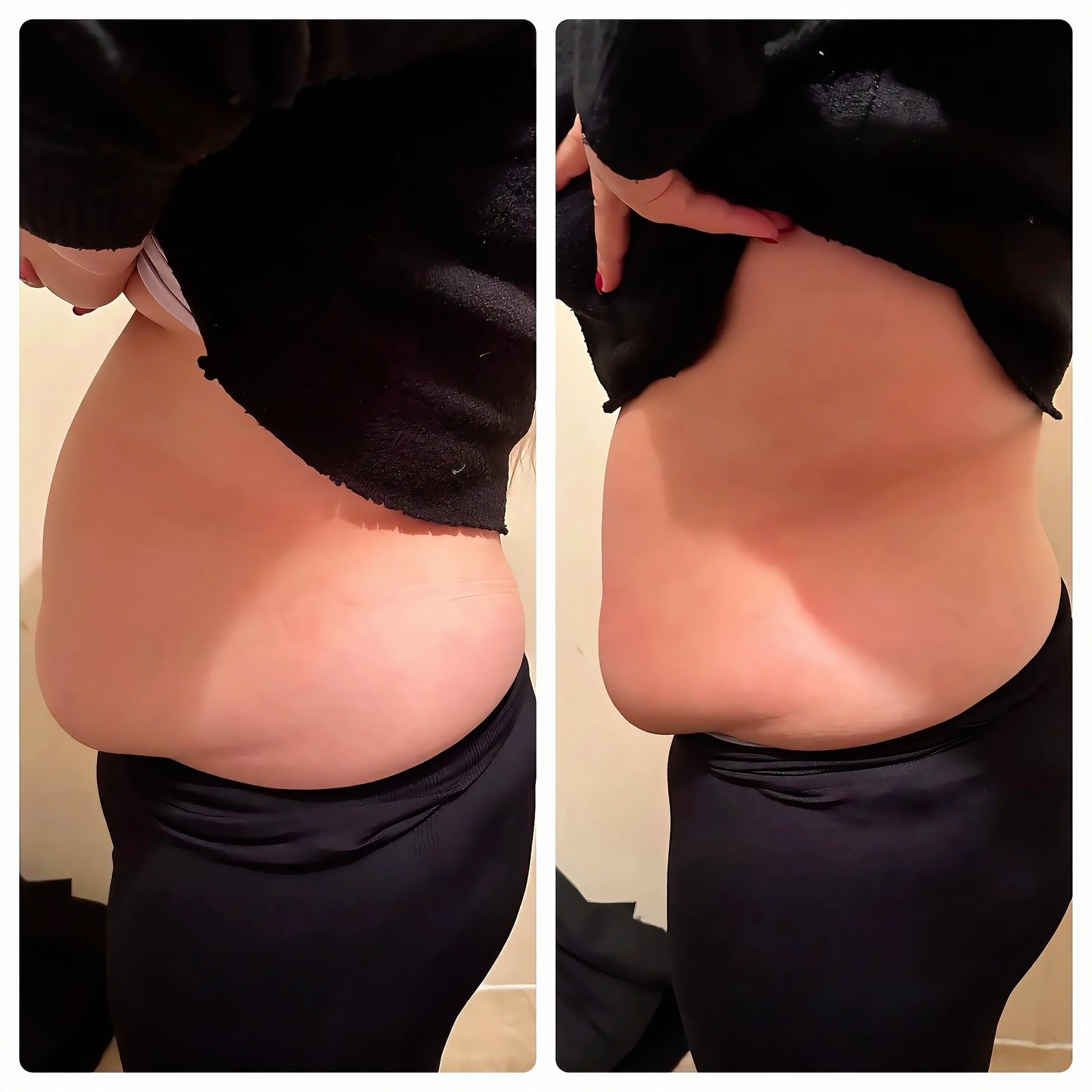 Side view of a client’s stomach before and after two fat freezing cryolipolysis sessions at Skintastic in Southampton