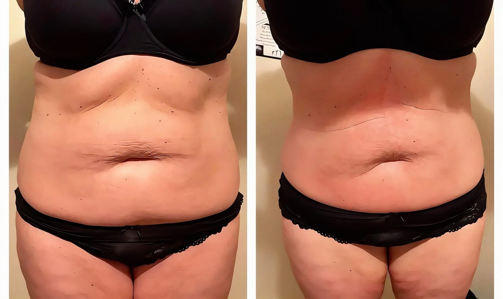 Front view of a client’s stomach before and after ten laser lipo, ultrasound cavitation and radio frequency sessions at Skintastic in Southampton