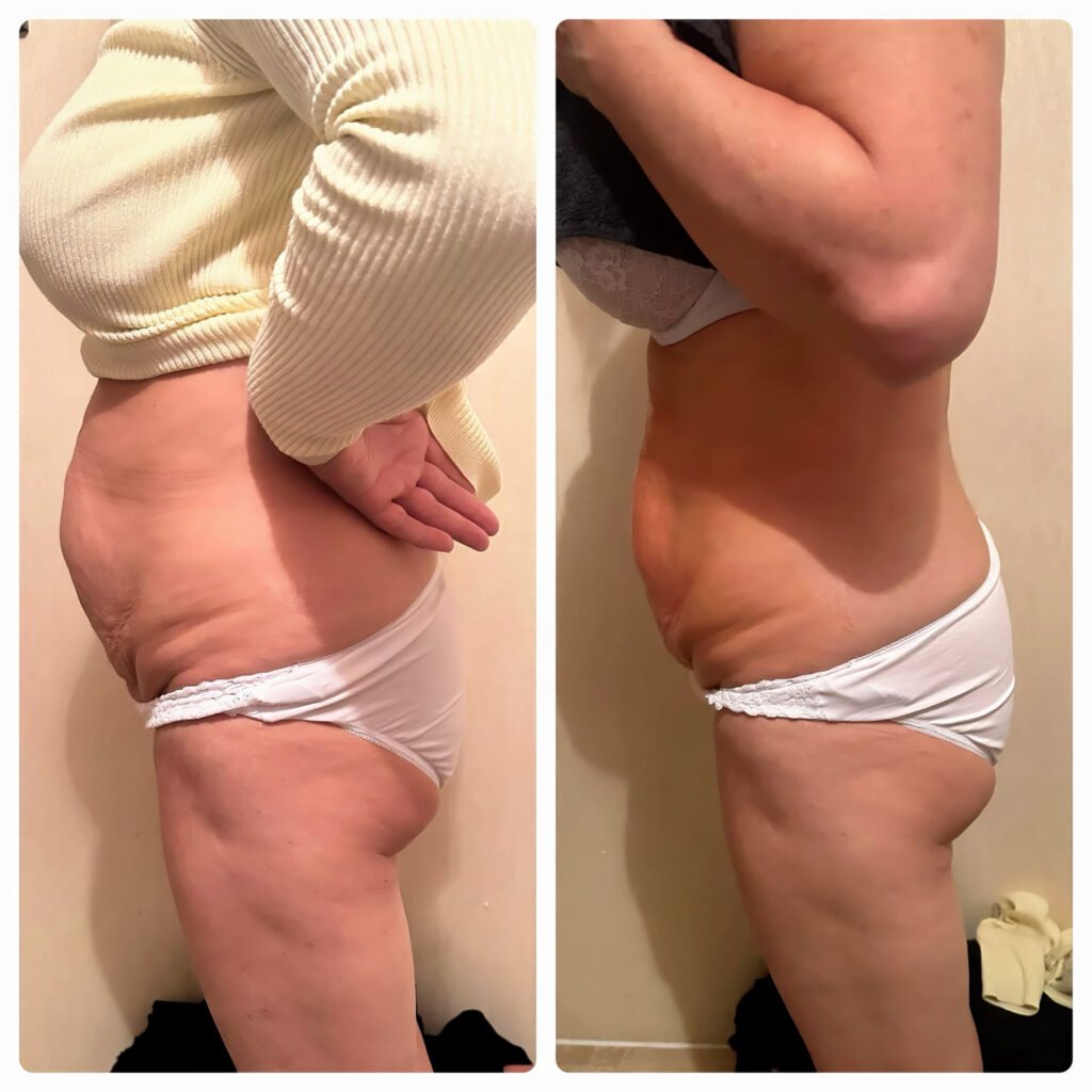 Side view of a client’s stomach before and after ten laser lipo, ultrasound cavitation and radio frequency sessions at Skintastic Southampton