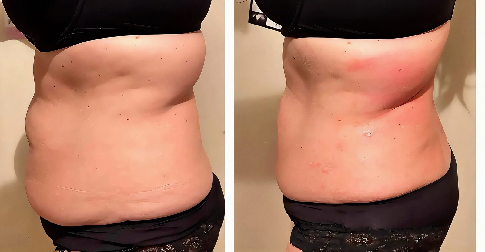 Side view of a client’s stomach and waist before and after three months of ultrasound cavitation at Skintastic in Southampton