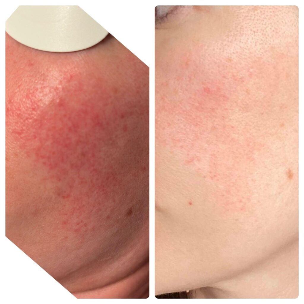 Before and after results of IPL treatment for facial redness and rosacea