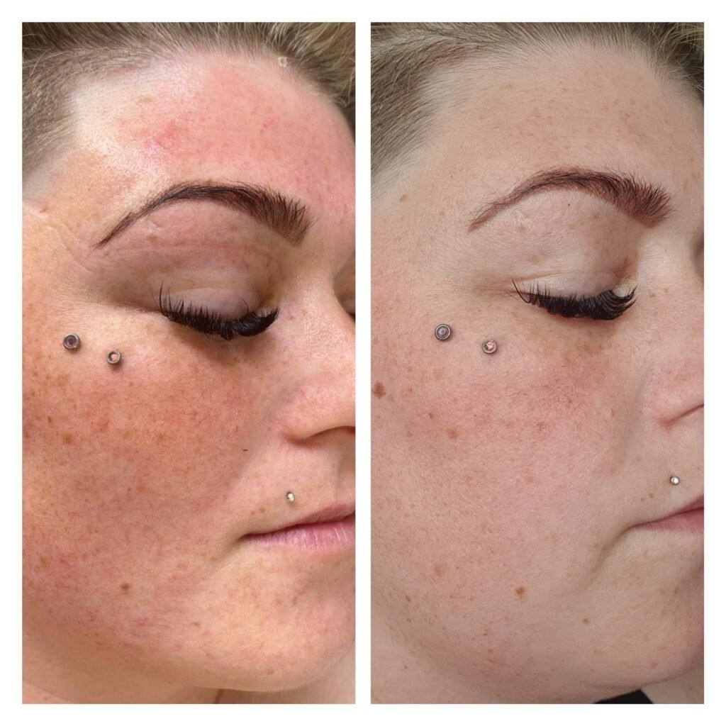 Before and after IPL photo rejuvenation for sun damage and redness at Skintastic Aesthetics