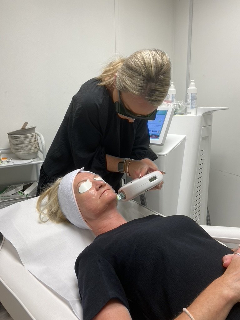 IPL photo rejuvenation treatment in progress at Skintastic Aesthetics