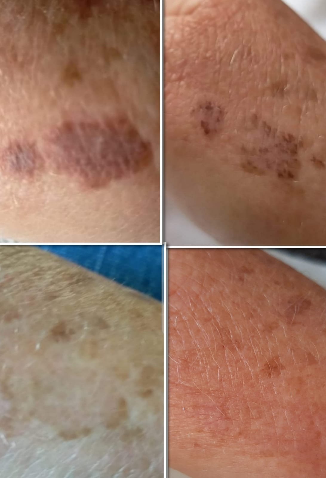 Before and after pigmentation removal on the arm at Skintastic Southampton