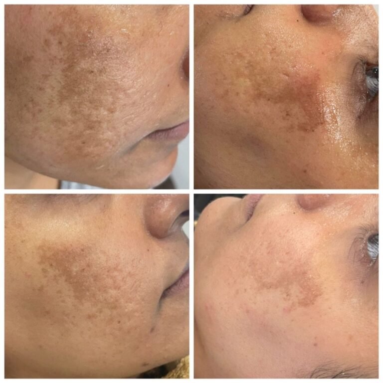 Before and after facial pigmentation treatment at Skintastic Aesthetics