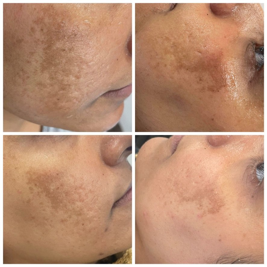 Before and after facial pigmentation treatment at Skintastic Aesthetics