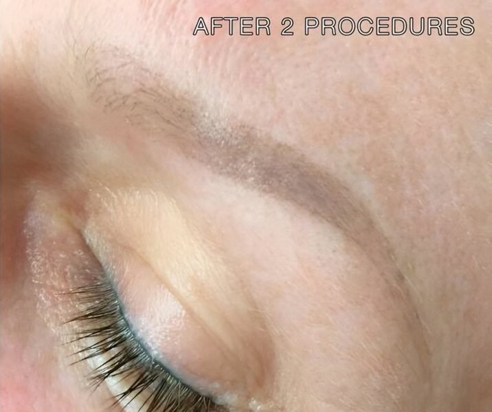 The same semi-permanent makeup brow after two laser removal treatments