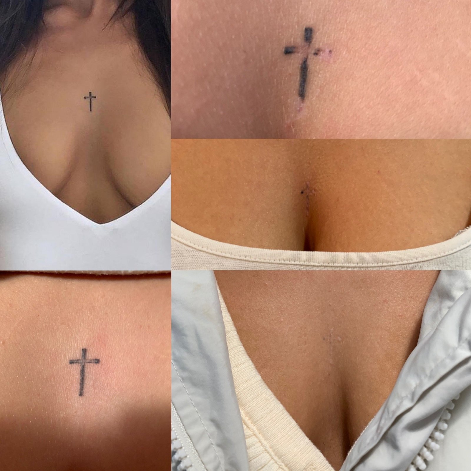 Before and after cross tattoo removal on the chest at Skintastic Aesthetics