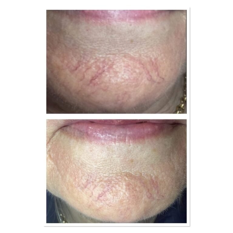 Before and after thread vein reduction on the chin for rosacea at Skintastic Aesthetics