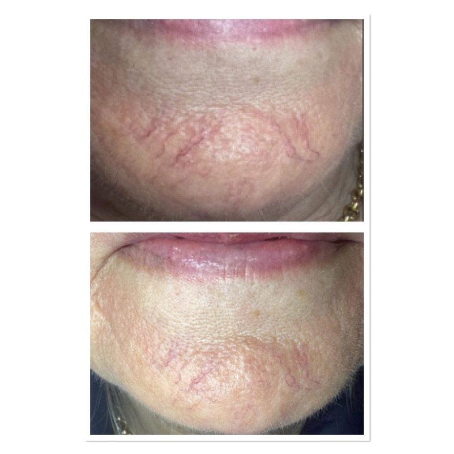 Before and after thread vein reduction on the chin for rosacea at Skintastic Aesthetics