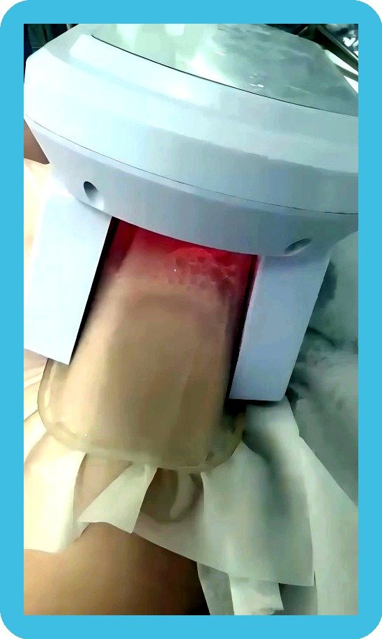 Fat freezing cryolipolysis treatment in progress - Skintastic Southampton