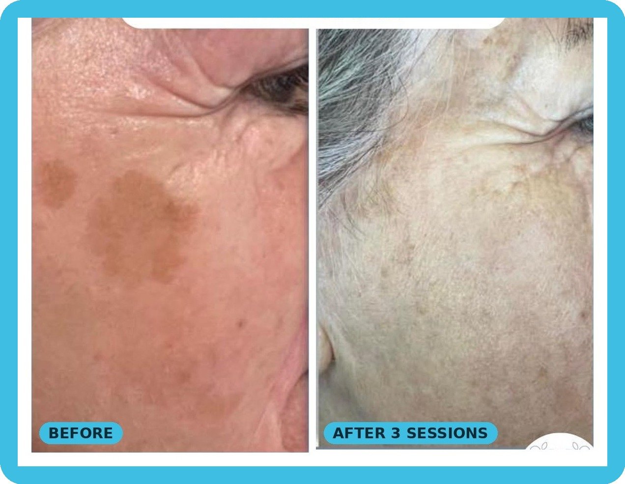 IPL treatment for sun spots after 3 sessions - Skintastic Southampton