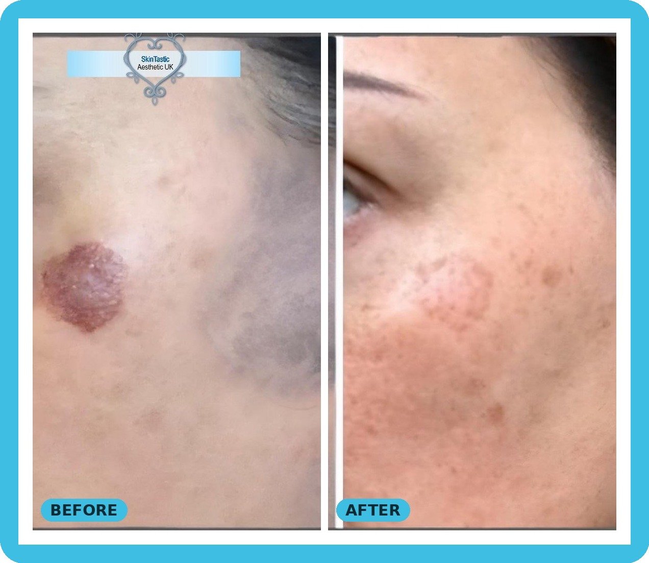 IPL pigmentation treatment on cheek before and after - Skintastic Southampton