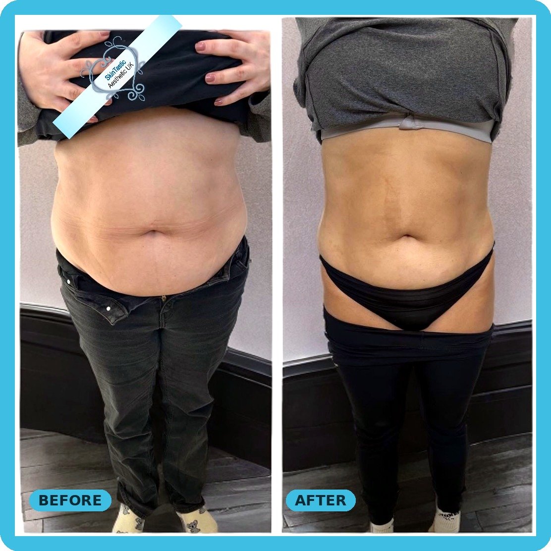 Body fat reduction before and after (fat freezing, cavitation and RF) - Skintastic Southampton