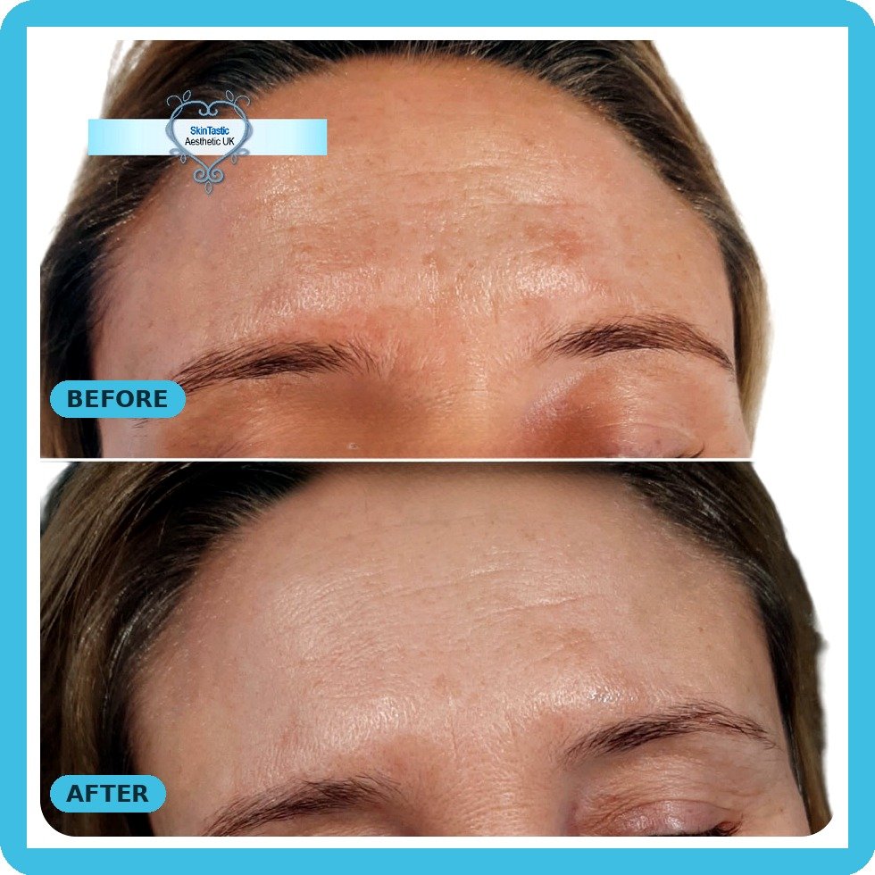 IPL pigmentation removal sun damage forehead after one session - Skintastic Southampton