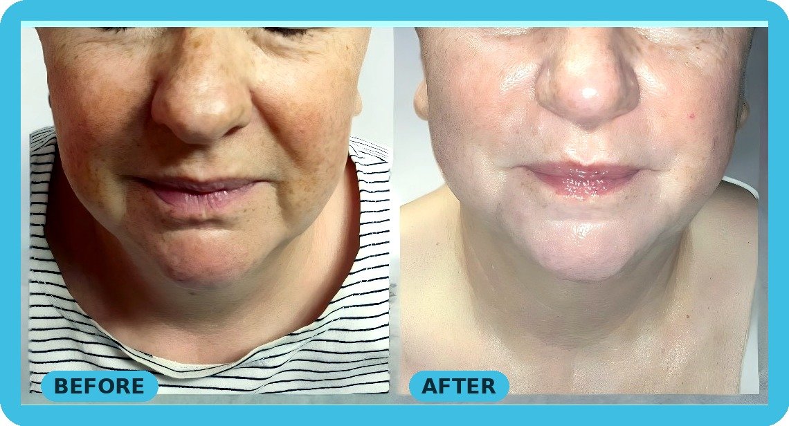 Carbon laser facial before and after, clearer brighter skin - Skintastic Aesthetics Southampton