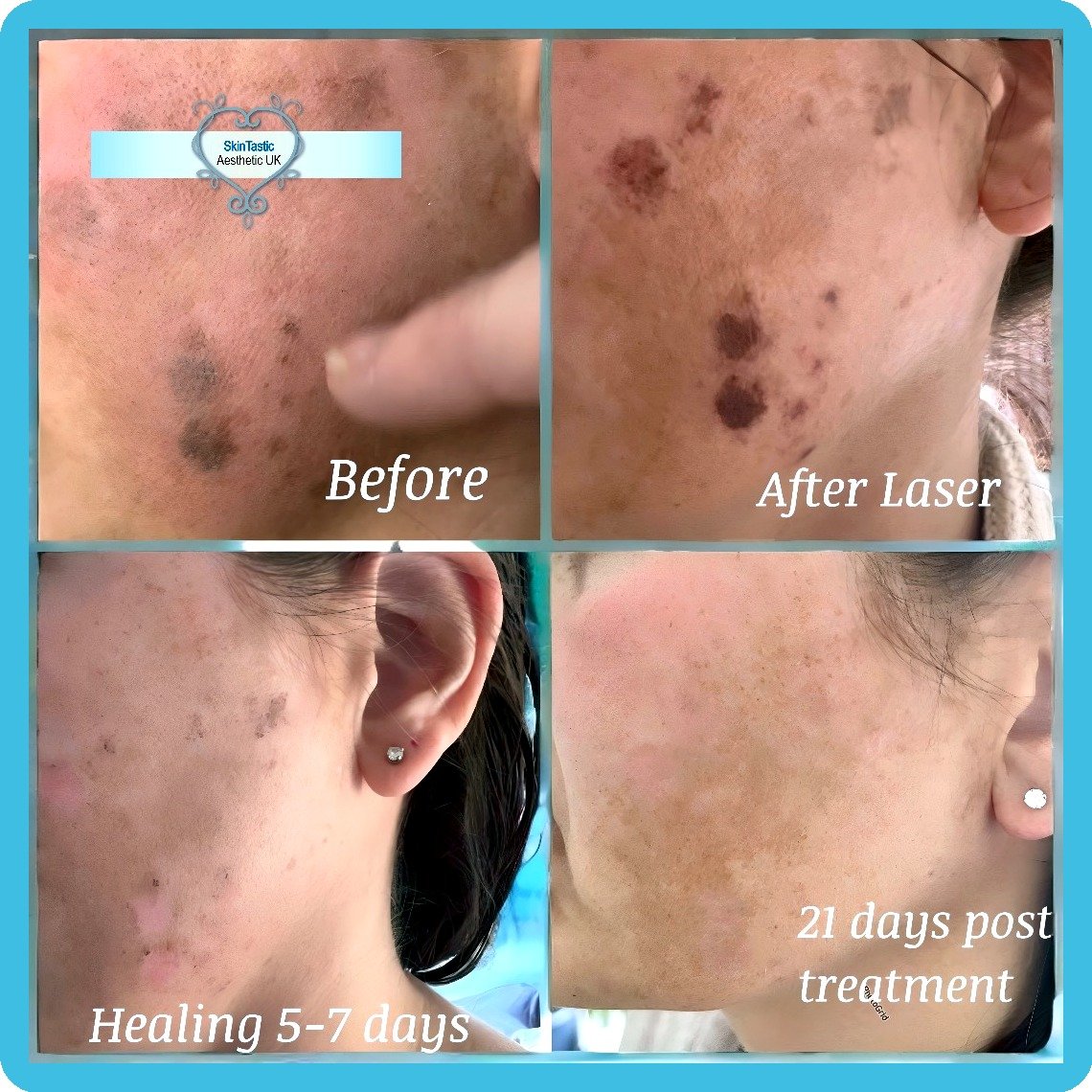 IPL pigmentation melasma treatment journey - before, after laser, healing, 21 days - Skintastic Southampton