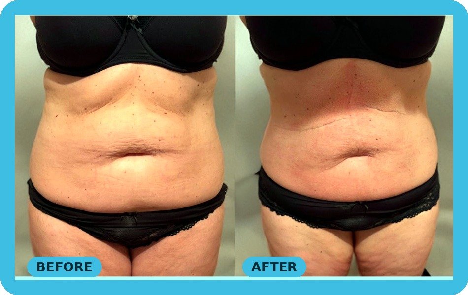 Fat freezing cryolipolysis tummy before and after - Skintastic Southampton