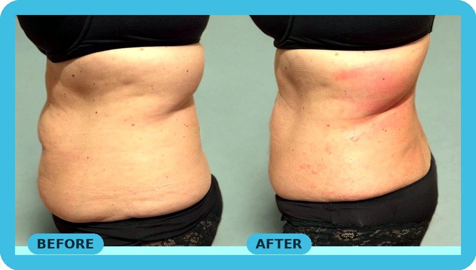 Body fat reduction before and after (fat freezing and fat-dissolving injections) - Skintastic Southampton
