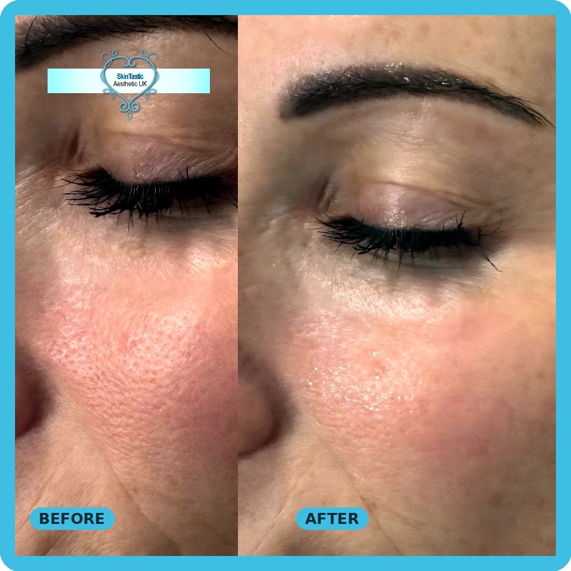 Carbon laser facial pore size reduction before and after - Skintastic Southampton